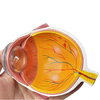 4X Cataract Eyeball Model Eye Various Cataracts Anatomy Teaching And Patient Demonstration Cataract