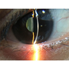 S150D China Ophthalmology 6X Portable Digital ORC Slit Lamp with Mobile Adapter App